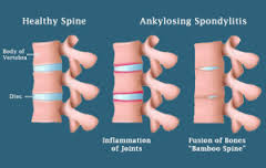 Spondylot Ankylosan ، الروماتيزم الفقري